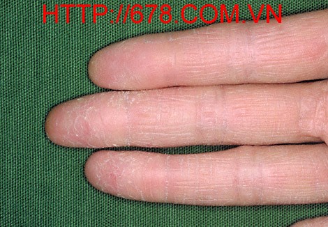 eczema bàn tay